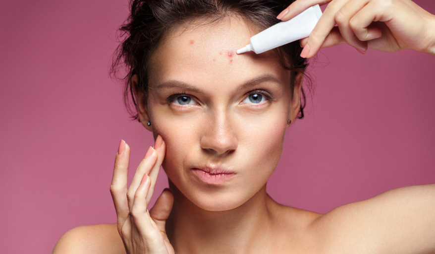 Understanding Acne & Breakouts: Causes, Concerns, and Solutions